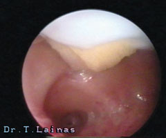 Osseous metaplasia.